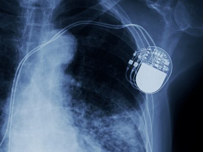 Life With a Pacemaker